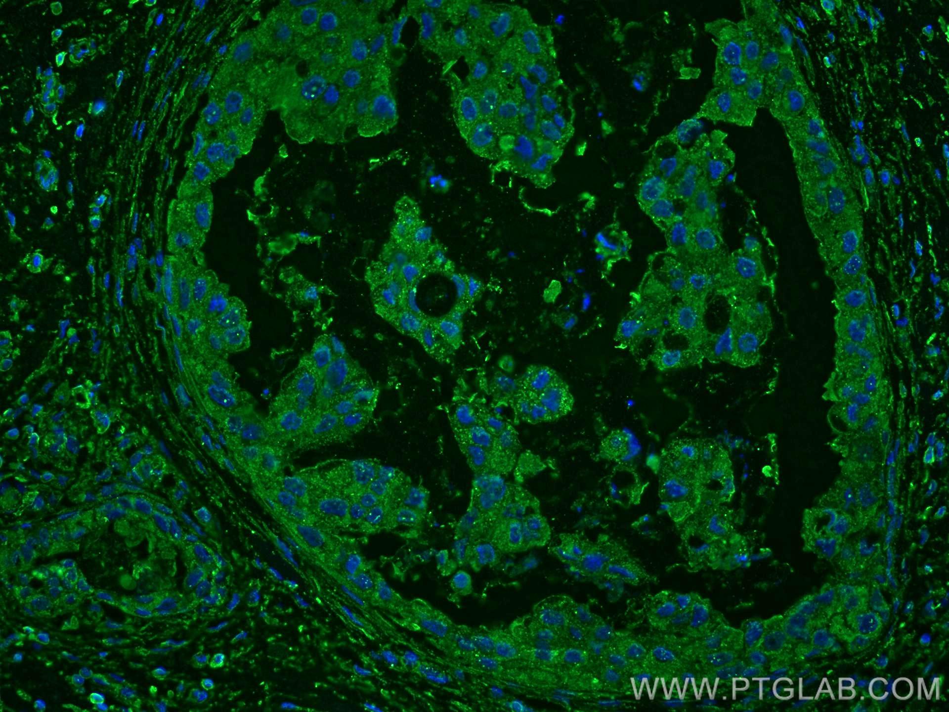 Immunofluorescence (IF) / fluorescent staining of human breast cancer tissue using KLK11 Monoclonal antibody (67427-1-Ig)