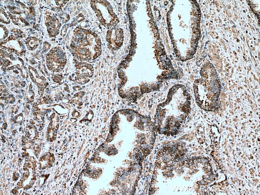 IHC staining of human prostate cancer using 67427-1-Ig