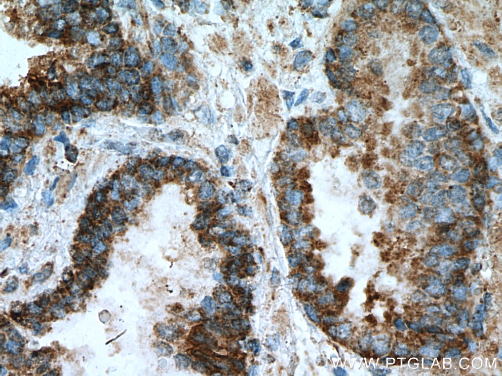 Immunohistochemistry (IHC) staining of human prostate cancer tissue using KLK11 Monoclonal antibody (67427-1-Ig)