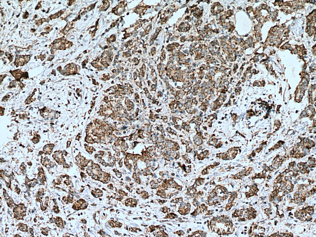 Immunohistochemistry (IHC) staining of human breast cancer tissue using KLK11 Monoclonal antibody (67427-1-Ig)