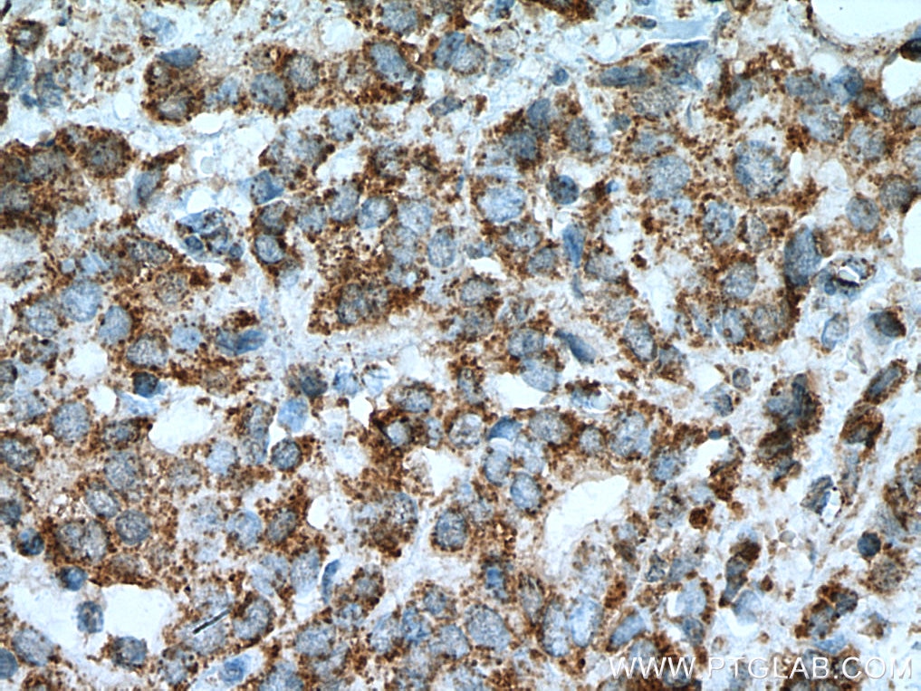 Immunohistochemistry (IHC) staining of human breast cancer tissue using KLK11 Monoclonal antibody (67427-1-Ig)