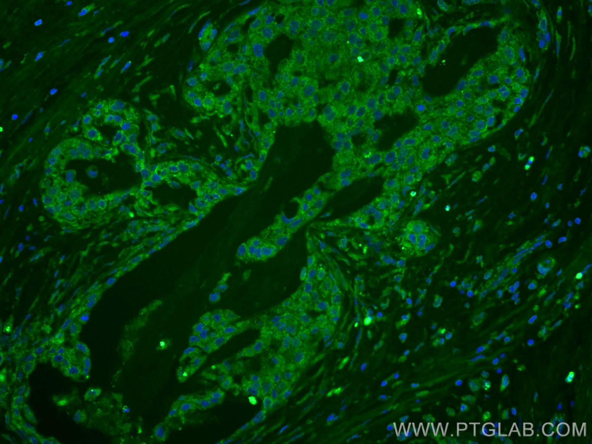 Immunofluorescence (IF) / fluorescent staining of human breast cancer tissue using CoraLite® Plus 488-conjugated KLK11 Monoclonal ant (CL488-67427)