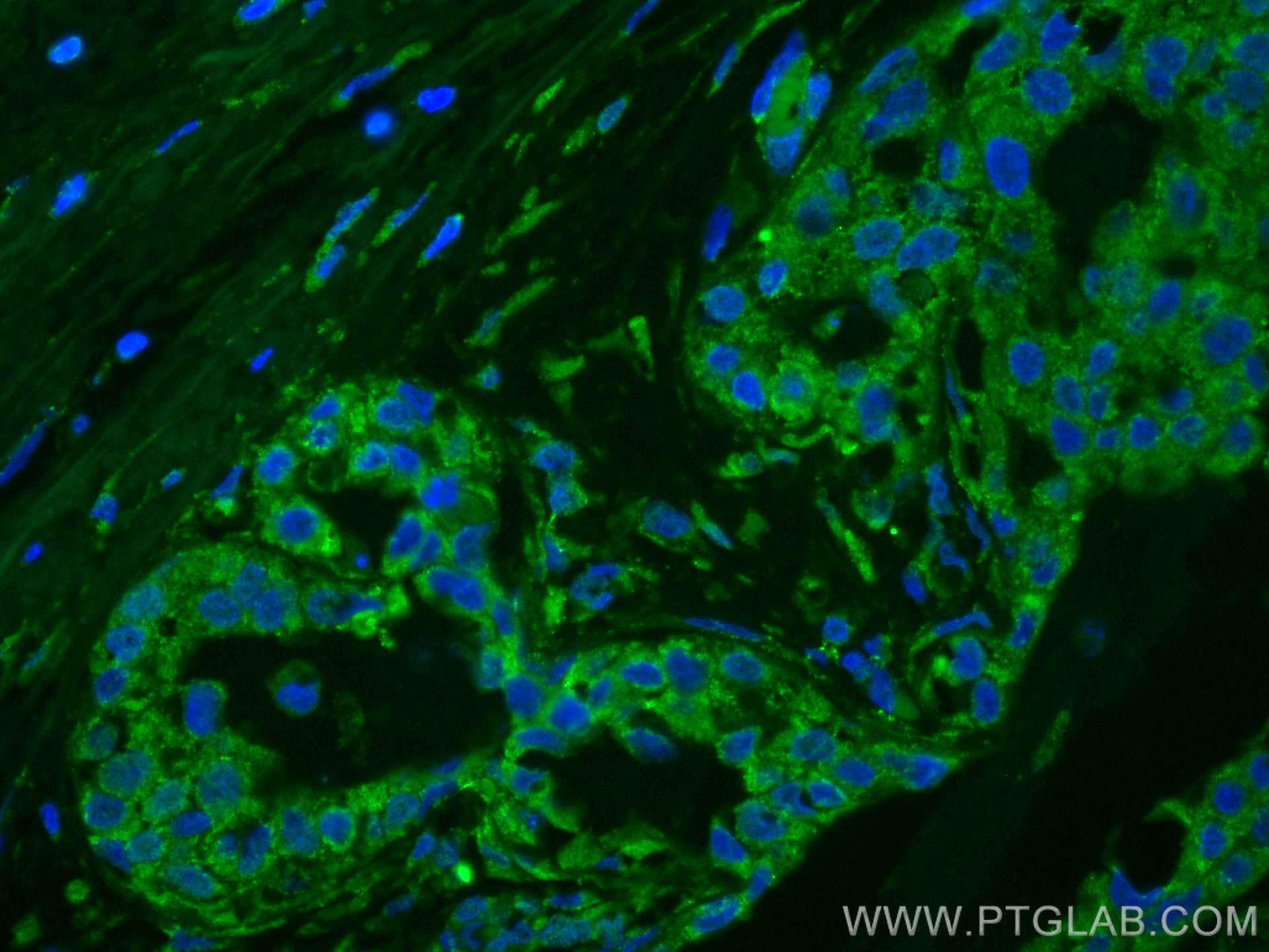 Immunofluorescence (IF) / fluorescent staining of human breast cancer tissue using CoraLite® Plus 488-conjugated KLK11 Monoclonal ant (CL488-67427)