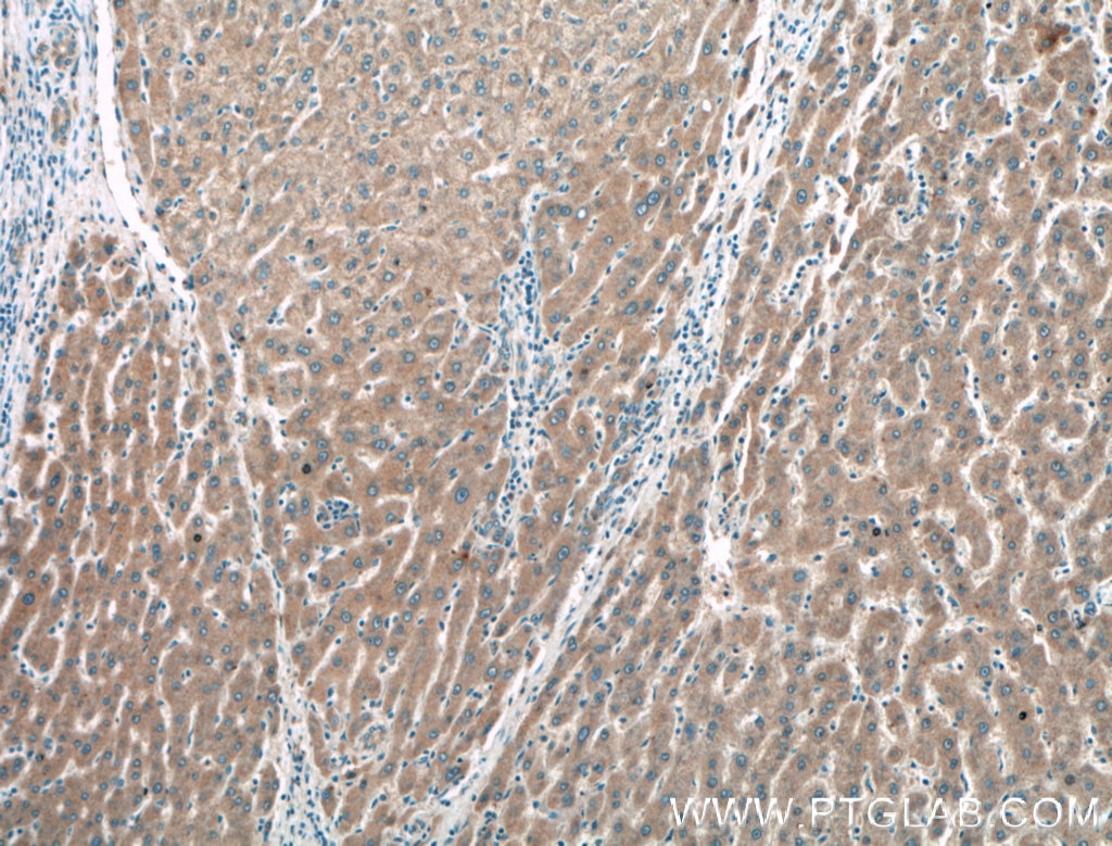 Immunohistochemistry (IHC) staining of human liver cancer tissue using KLK15 Polyclonal antibody (27515-1-AP)