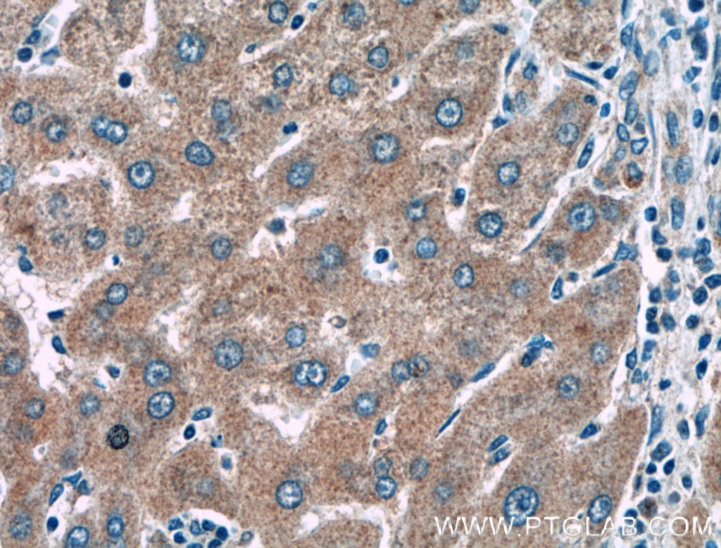 IHC staining of human liver cancer using 27515-1-AP
