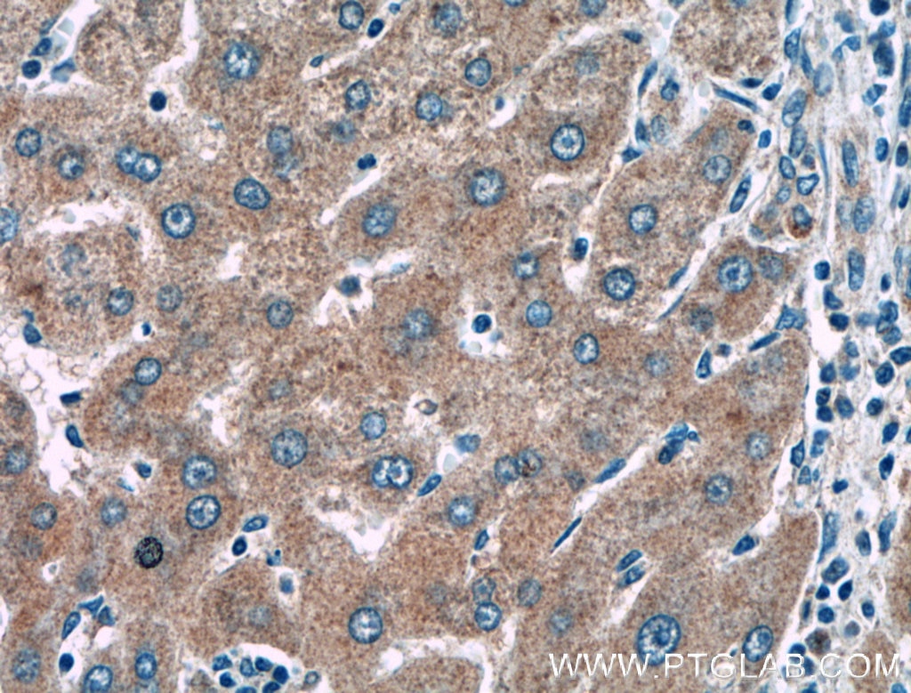 Immunohistochemistry (IHC) staining of human liver cancer tissue using KLK15 Polyclonal antibody (27515-1-AP)