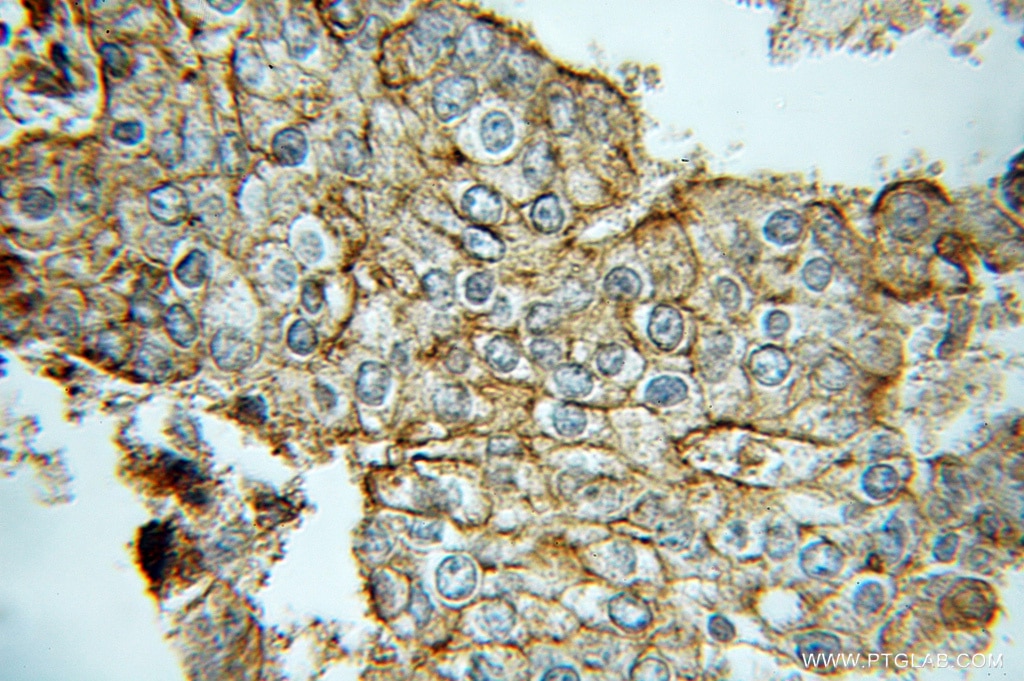 Immunohistochemistry (IHC) staining of human prostate cancer tissue using Kallikrein 2 Polyclonal antibody (10812-1-AP)
