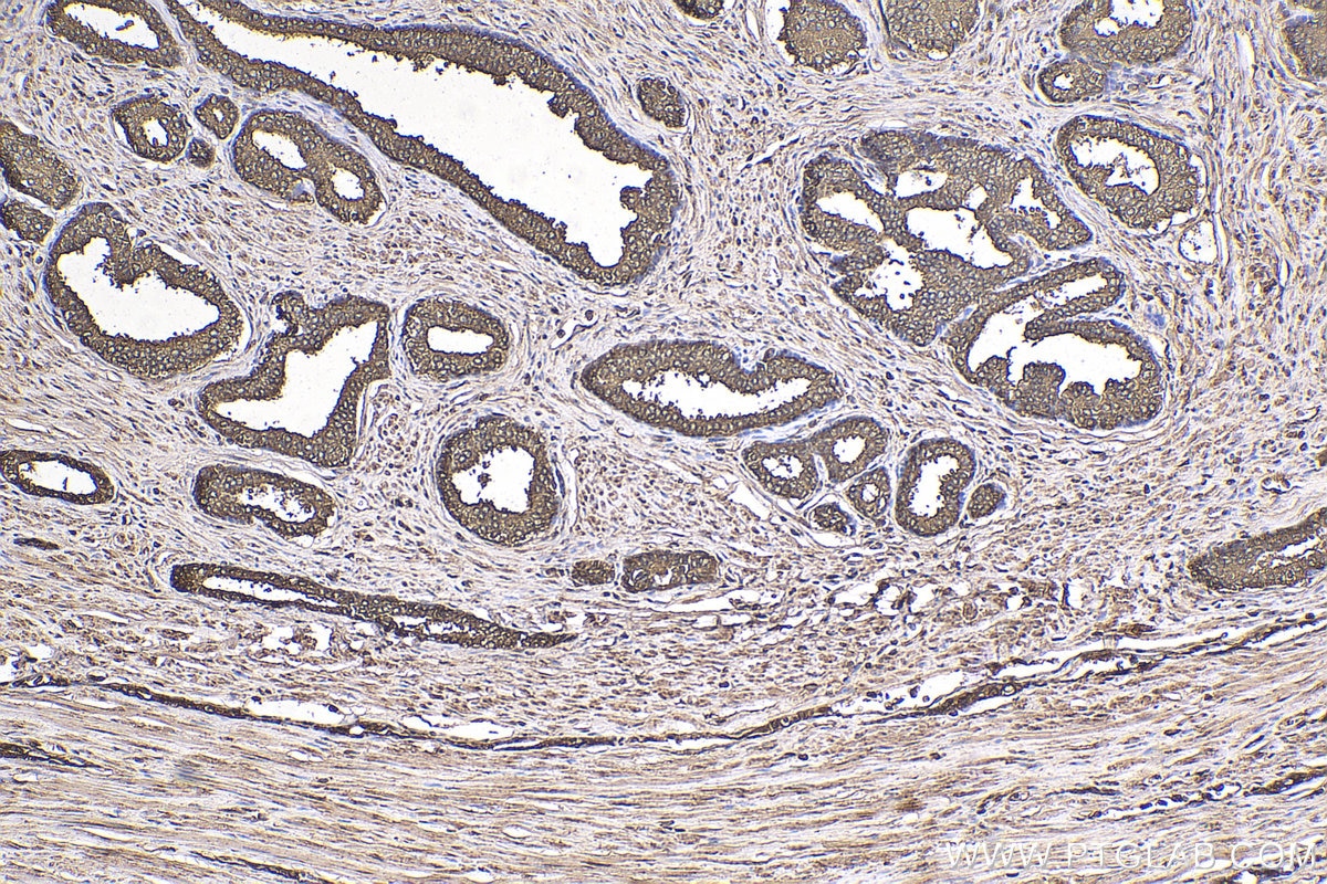 IHC staining of human prostate cancer using 10679-1-AP