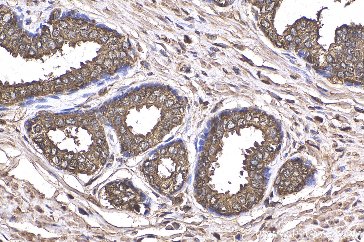 Immunohistochemistry (IHC) staining of human prostate cancer tissue using KLK3/PSA Polyclonal antibody (10679-1-AP)