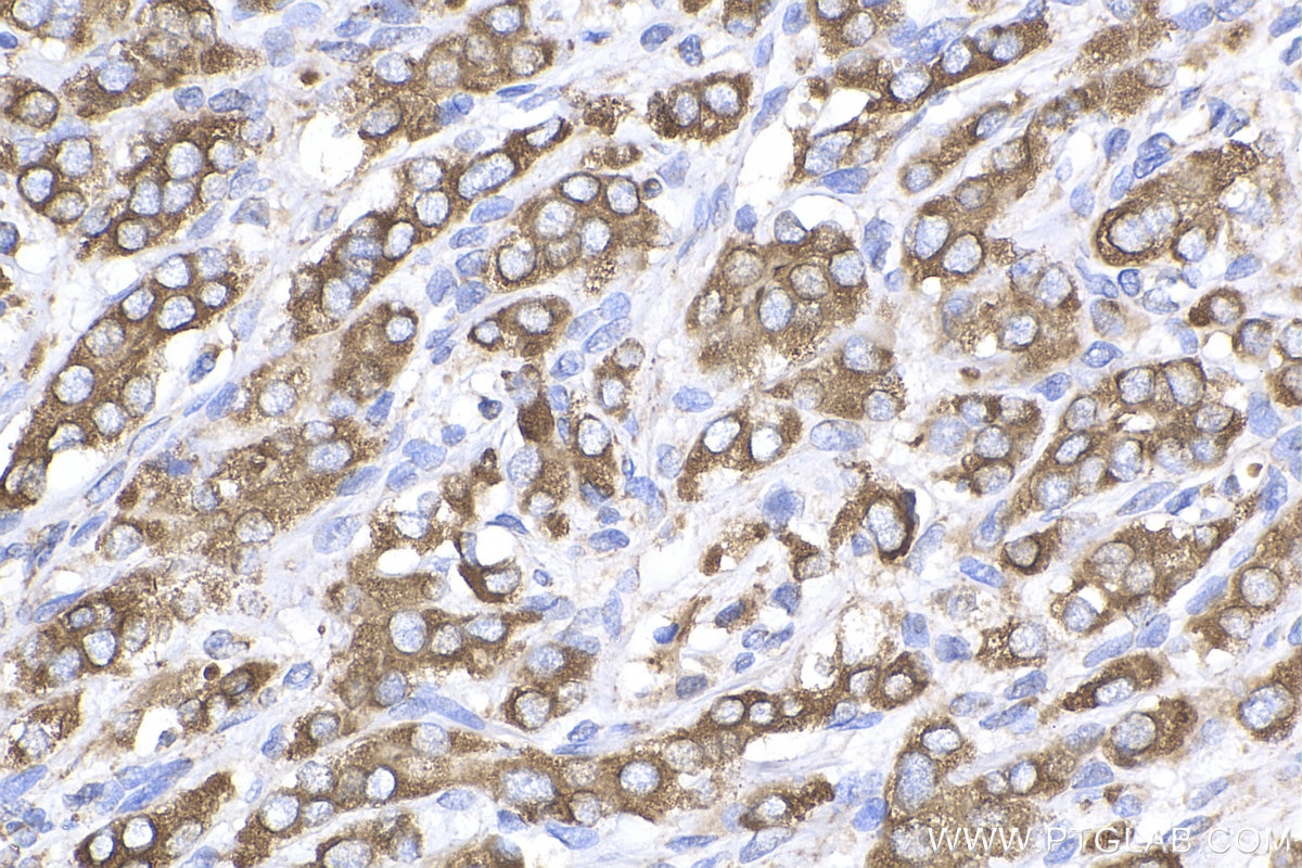 Immunohistochemistry (IHC) staining of human prostate cancer tissue using KLK3/PSA Polyclonal antibody (10679-1-AP)