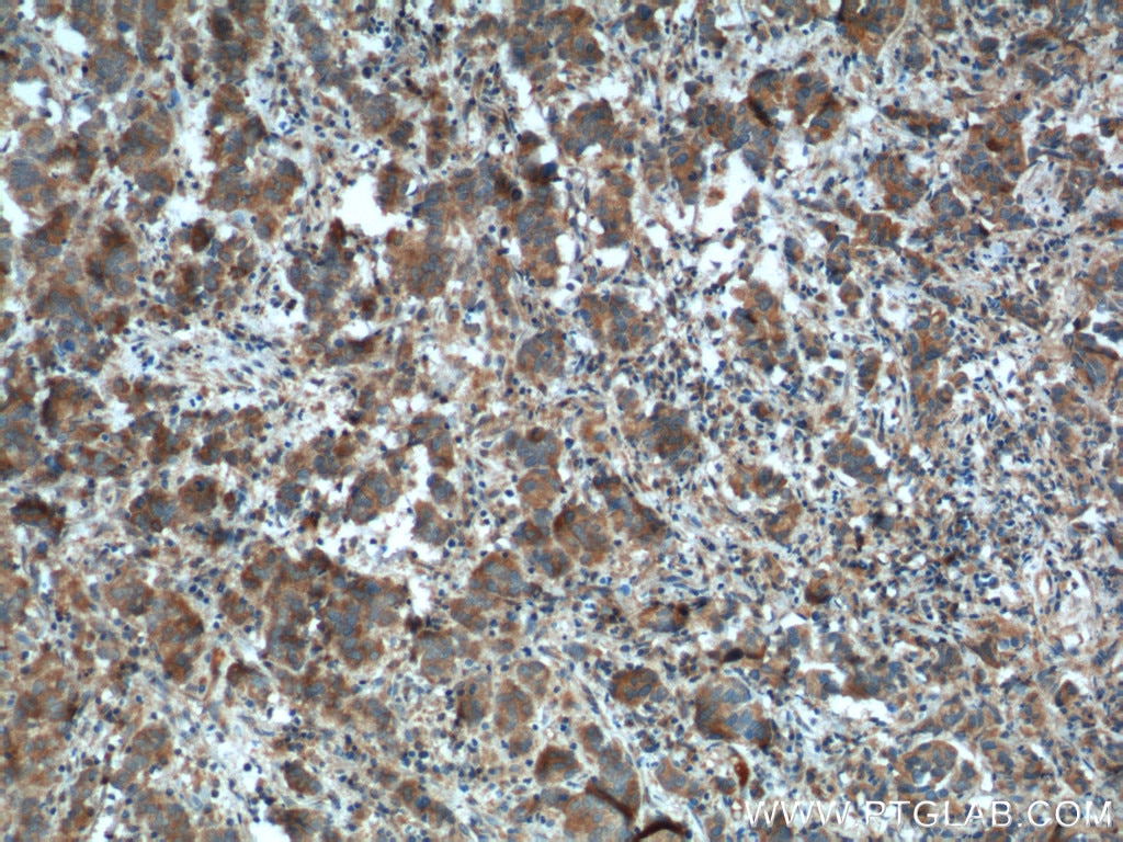 Immunohistochemistry (IHC) staining of human prostate cancer tissue using KLK3/PSA Polyclonal antibody (10679-1-AP)