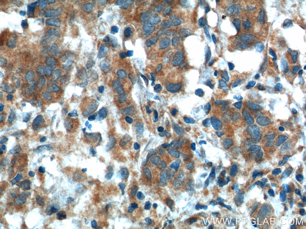 Immunohistochemistry (IHC) staining of human prostate cancer tissue using KLK3/PSA Polyclonal antibody (10679-1-AP)