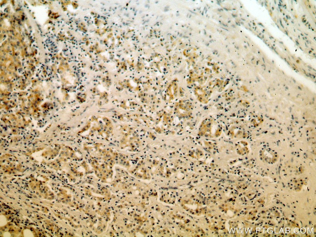 Immunohistochemistry (IHC) staining of human prostate cancer tissue using KLK3/PSA Polyclonal antibody (10679-1-AP)