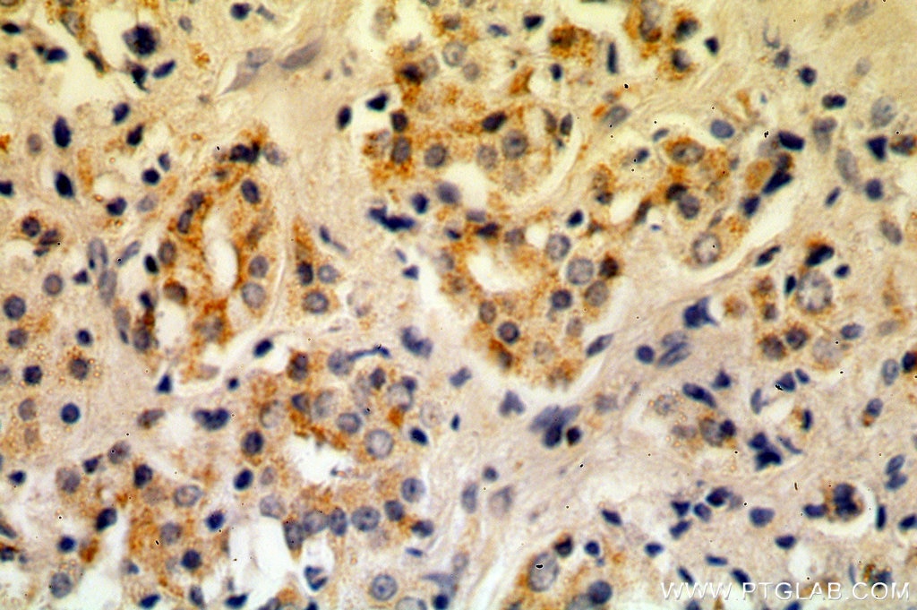 Immunohistochemistry (IHC) staining of human prostate cancer tissue using KLK3/PSA Polyclonal antibody (10679-1-AP)