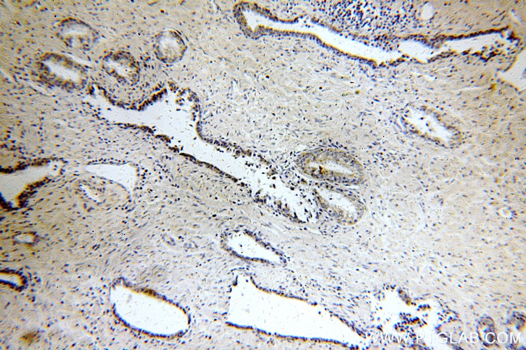 Immunohistochemistry (IHC) staining of human prostate cancer tissue using KLK3/PSA Polyclonal antibody (10679-1-AP)