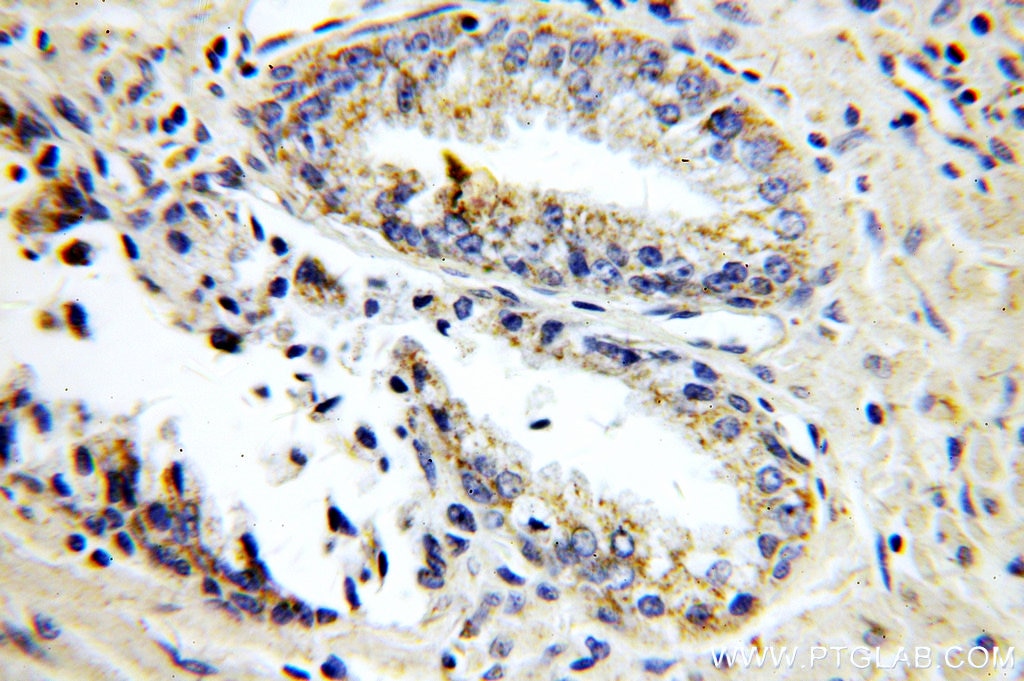 IHC staining of human prostate cancer using 10679-1-AP