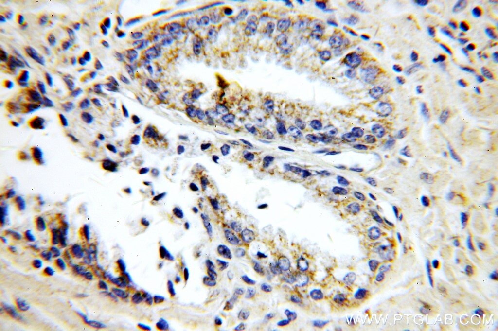 Immunohistochemistry (IHC) staining of human prostate cancer tissue using KLK3/PSA Polyclonal antibody (10679-1-AP)