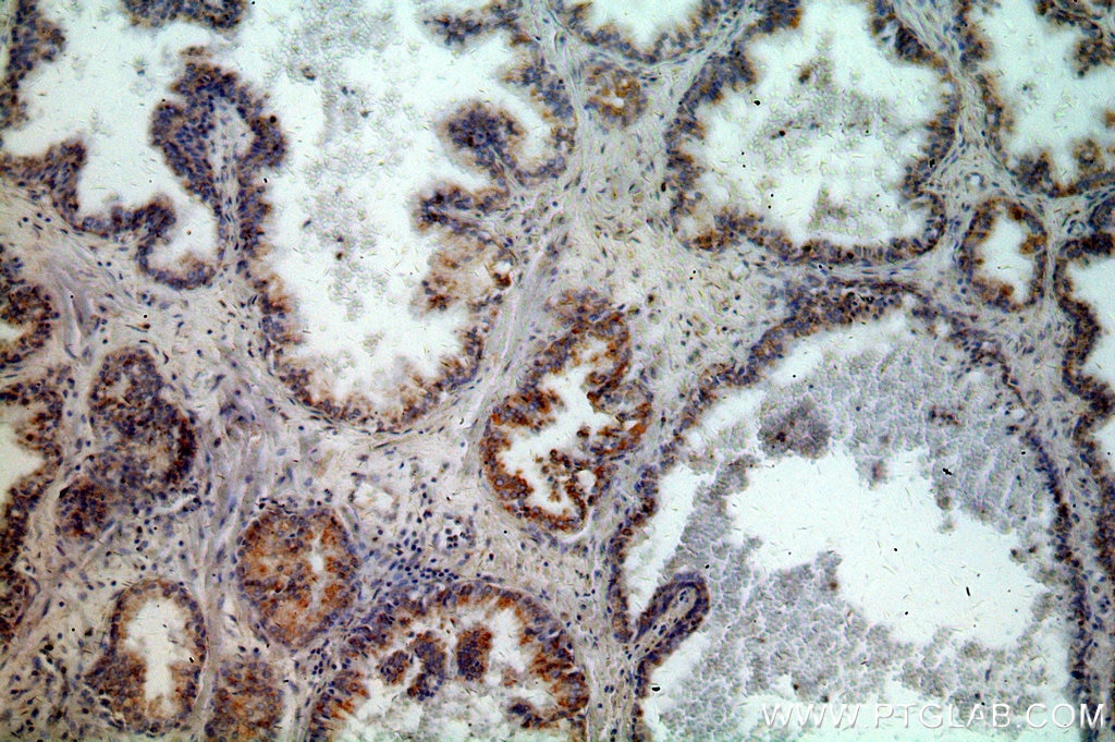 Immunohistochemistry (IHC) staining of human prostate cancer tissue using KLK3/PSA Polyclonal antibody (10679-1-AP)