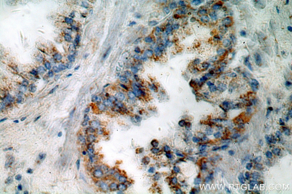 Immunohistochemistry (IHC) staining of human prostate cancer tissue using KLK3/PSA Polyclonal antibody (10679-1-AP)