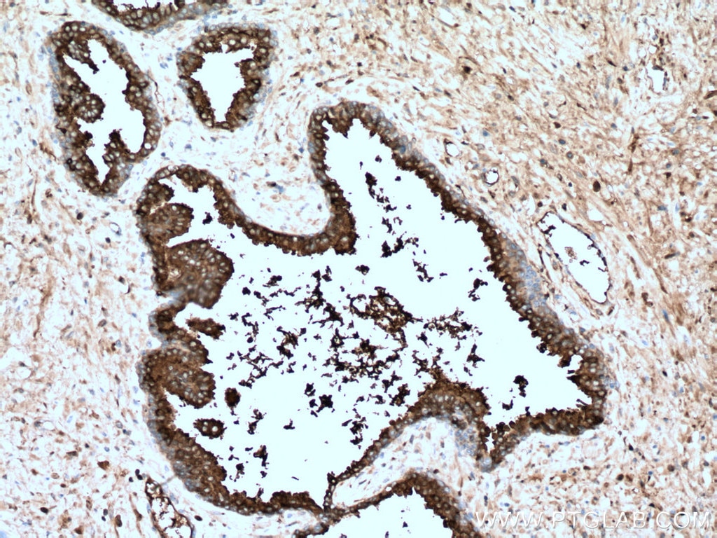 IHC staining of human prostate cancer using 60338-1-Ig