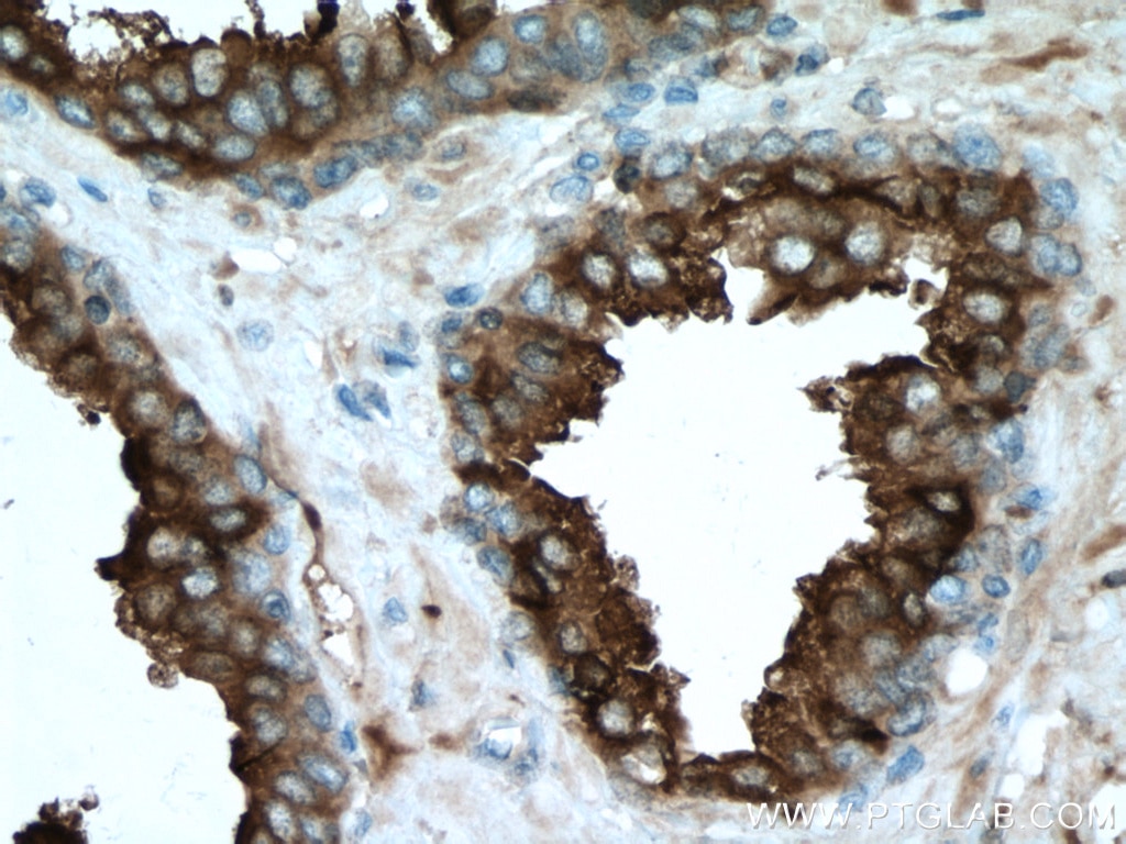 Immunohistochemistry (IHC) staining of human prostate cancer tissue using KLK3/PSA Monoclonal antibody (60338-1-Ig)