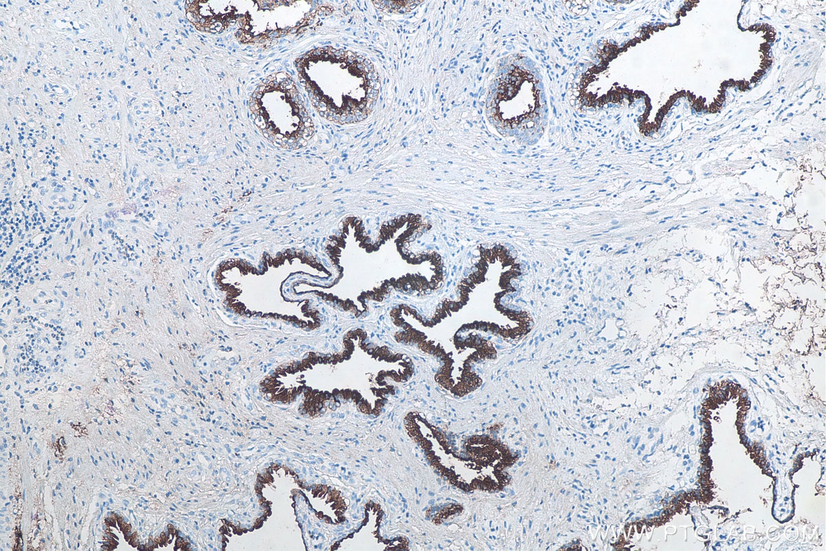 Immunohistochemistry (IHC) staining of human prostate cancer tissue using KLK3/PSA Monoclonal antibody (60338-1-Ig)