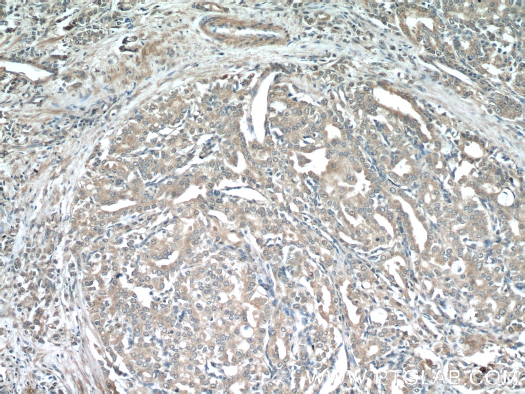 Immunohistochemistry (IHC) staining of human prostate cancer tissue using KLK3/PSA Monoclonal antibody (60338-1-Ig)