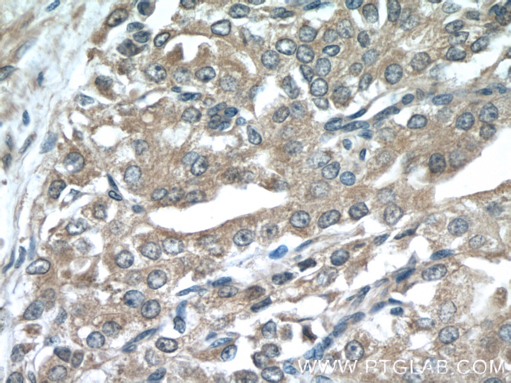 Immunohistochemistry (IHC) staining of human prostate cancer tissue using KLK3/PSA Monoclonal antibody (60338-1-Ig)