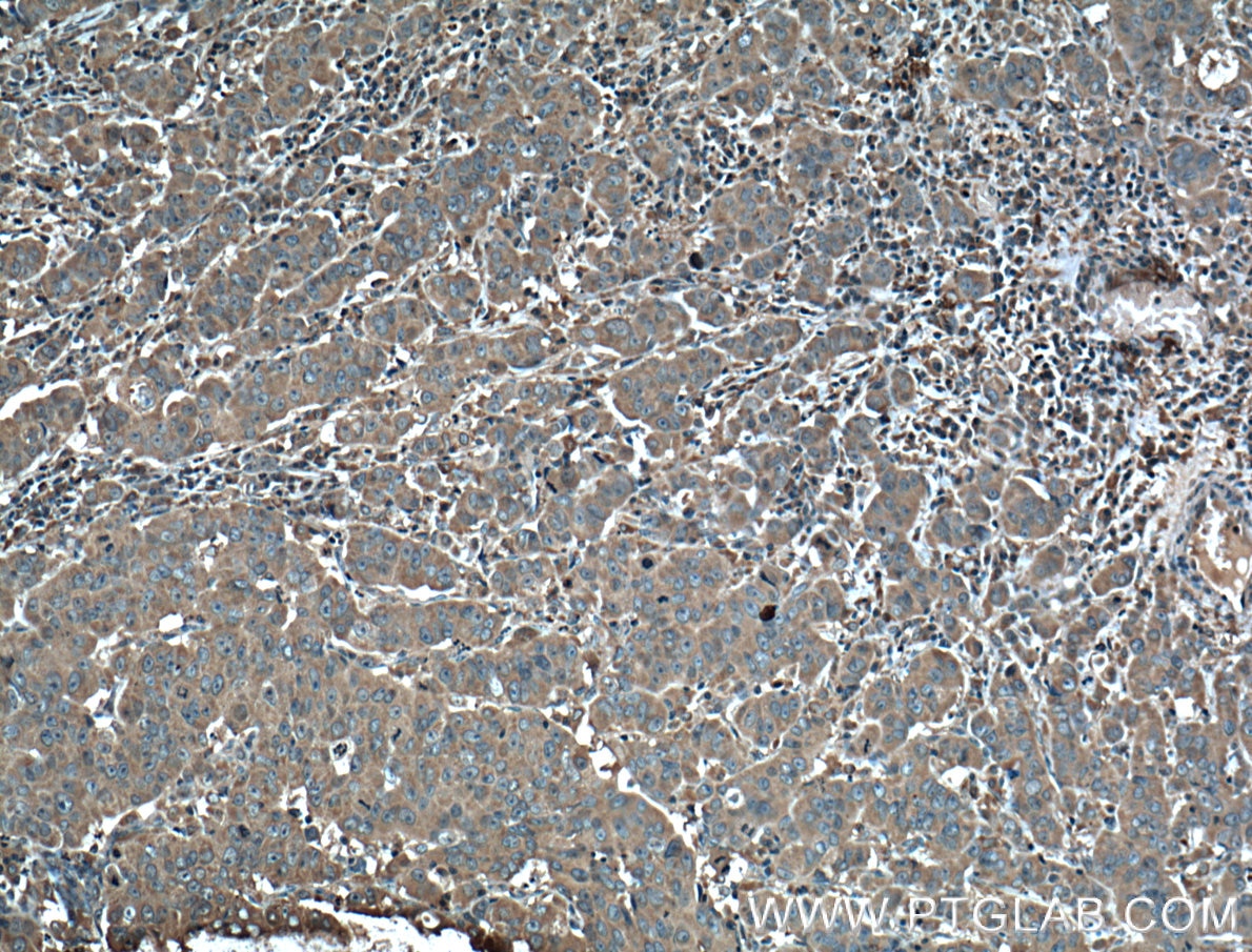 Immunohistochemistry (IHC) staining of human prostate cancer tissue using KLK3/PSA Monoclonal antibody (60338-1-Ig)
