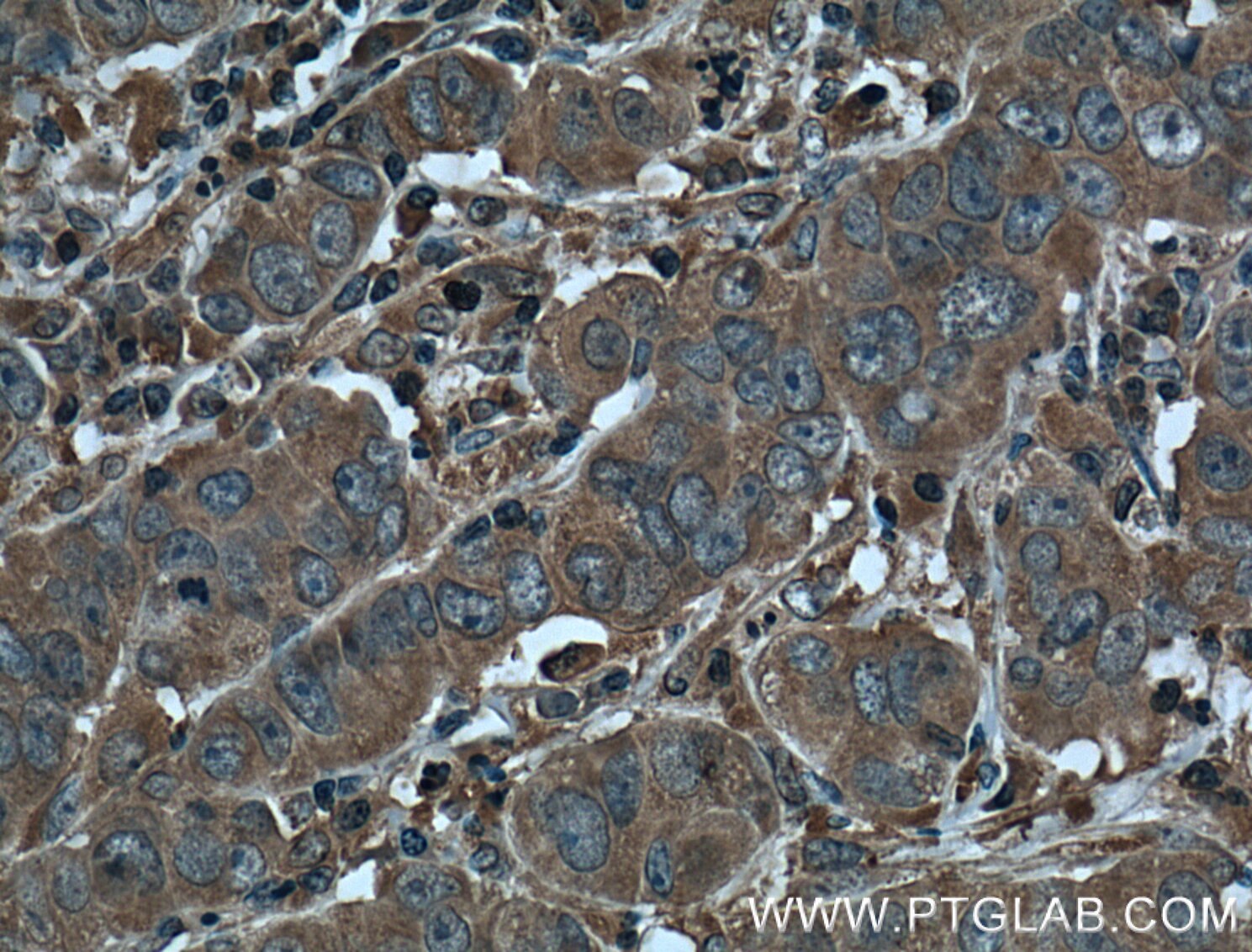 IHC staining of human prostate cancer using 60338-1-Ig