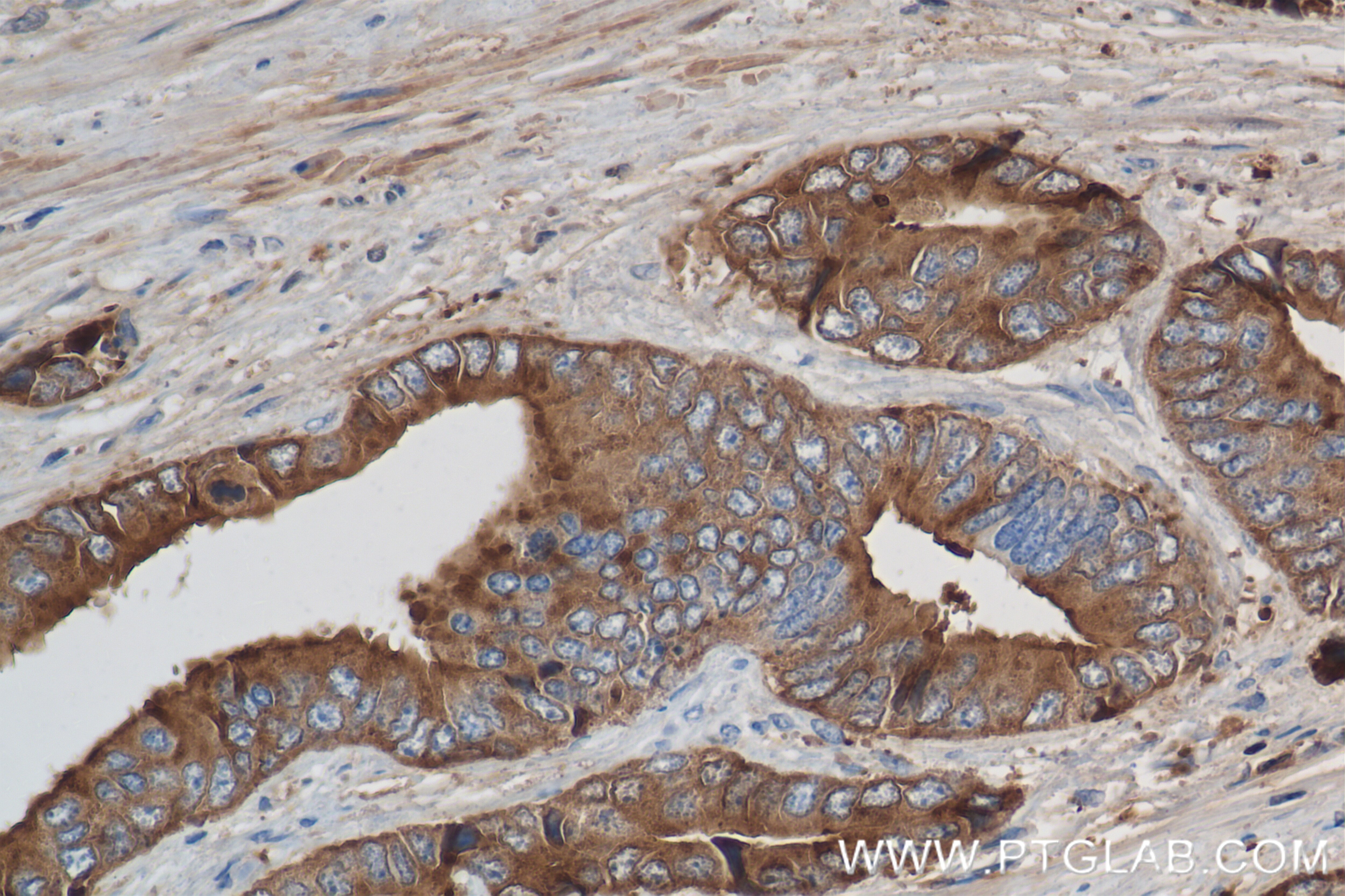Immunohistochemistry (IHC) staining of human prostate cancer tissue using KLK3/PSA Recombinant antibody (84059-5-RR)