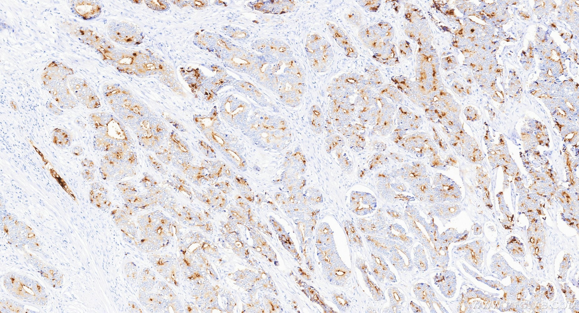 Immunohistochemistry (IHC) staining of human prostate cancer tissue using KLK3/PSA Recombinant monoclonal antibody (84059-6-RR)