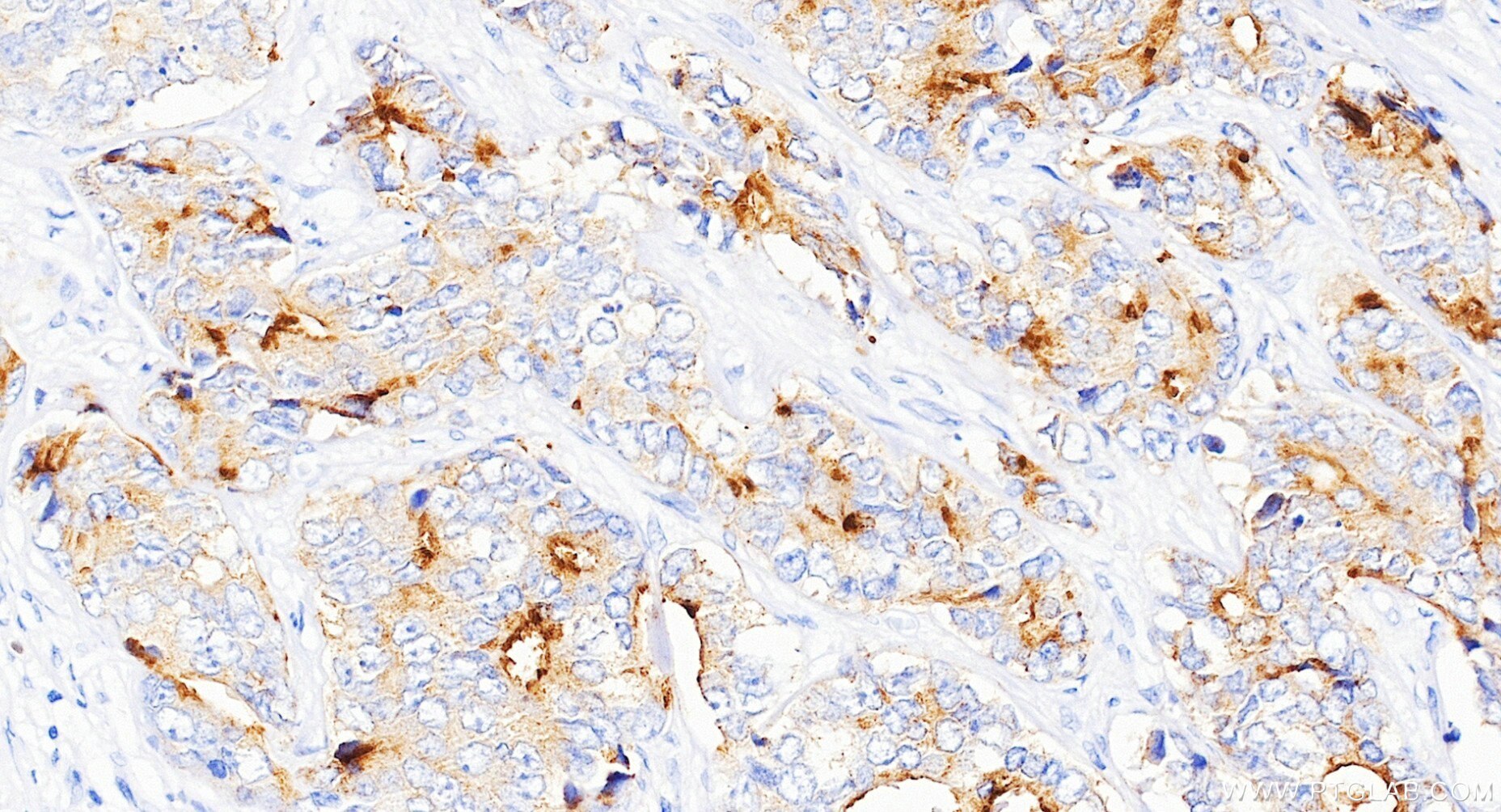 Immunohistochemistry (IHC) staining of human prostate cancer tissue using KLK3/PSA Recombinant monoclonal antibody (84059-6-RR)