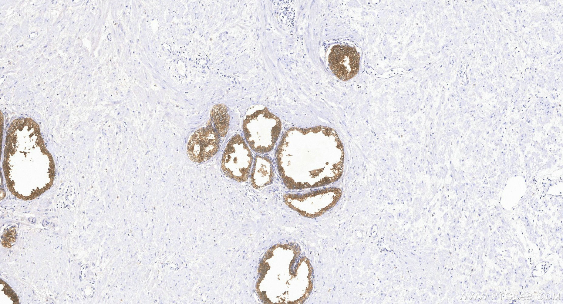IHC staining of human prostate using 84059-7-RR Immunohistochemistry (IHC) staining of human prostate tissue using KLK3/PSA Recombinant monoclonal antibody (84059-7-RR)