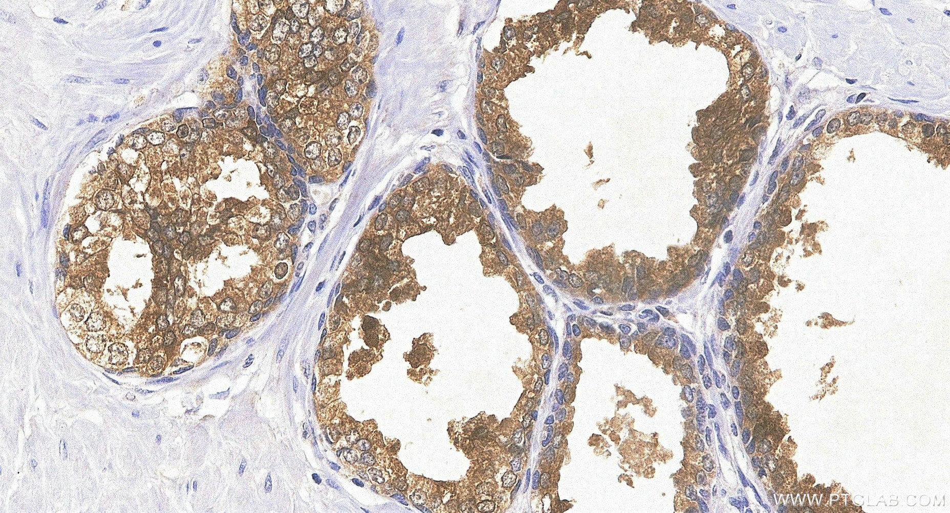 IHC staining of human prostate using 84059-7-RR Immunohistochemistry (IHC) staining of human prostate tissue using KLK3/PSA Recombinant monoclonal antibody (84059-7-RR)