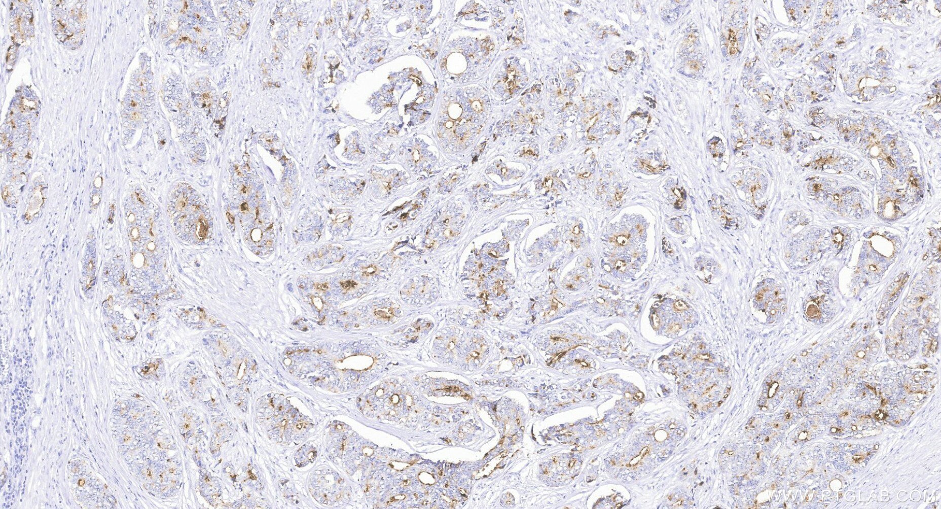 IHC staining of Human Prostate Cancer using 84059-7-RR Immunohistochemistry (IHC) staining of Human Prostate Cancer tissue using KLK3/PSA Recombinant monoclonal antibody (84059-7-RR)