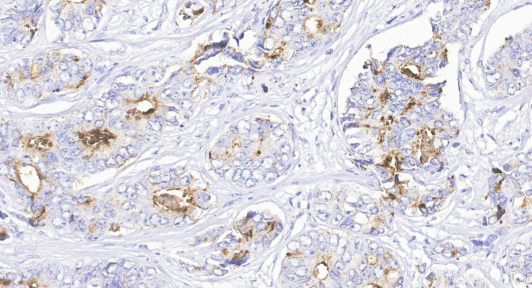 IHC staining of Human Prostate Cancer using 84059-7-RR Immunohistochemistry (IHC) staining of Human Prostate Cancer tissue using KLK3/PSA Recombinant monoclonal antibody (84059-7-RR)