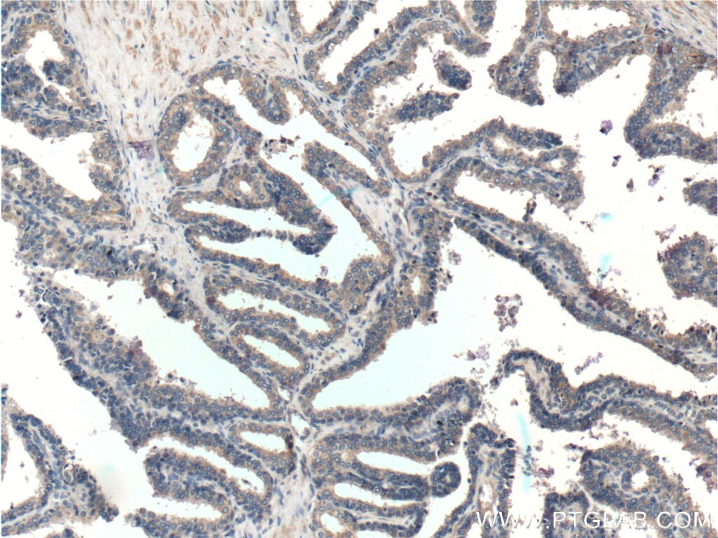 Immunohistochemistry (IHC) staining of human prostate hyperplasia tissue using KLK4 Polyclonal antibody (26547-1-AP)