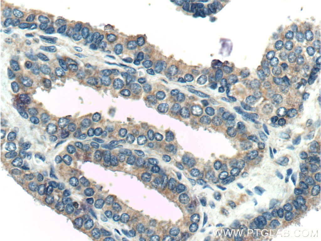 Immunohistochemistry (IHC) staining of human prostate hyperplasia tissue using KLK4 Polyclonal antibody (26547-1-AP)