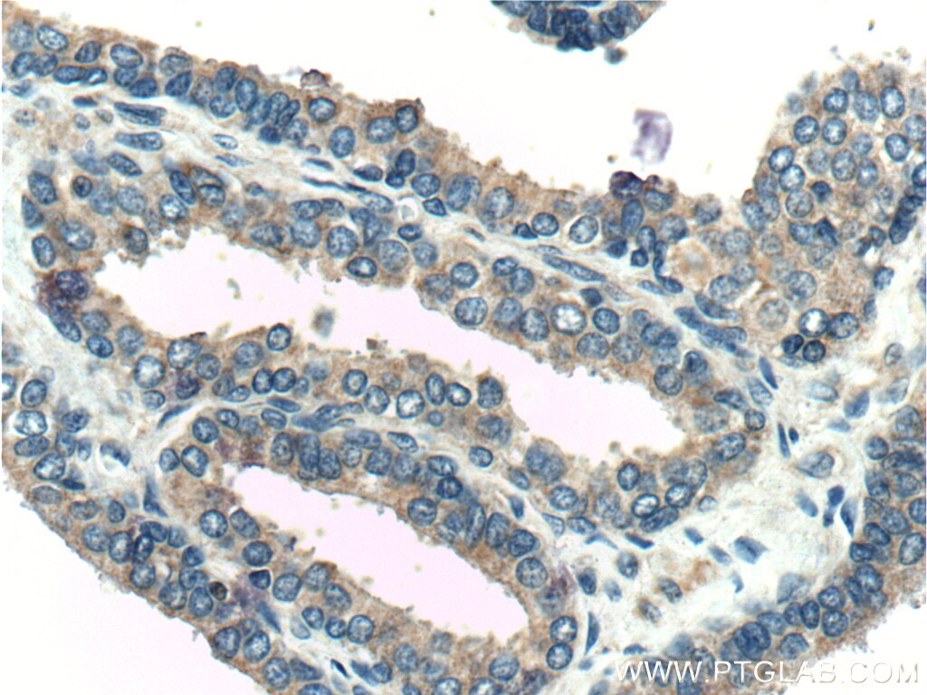 IHC staining of human prostate hyperplasia using 26547-1-AP