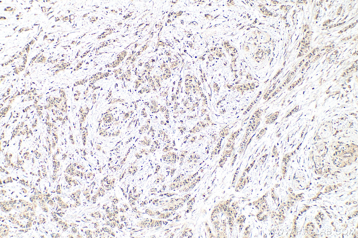 Immunohistochemistry (IHC) staining of human breast cancer tissue using Kallikrein 6 Polyclonal antibody (12264-1-AP)