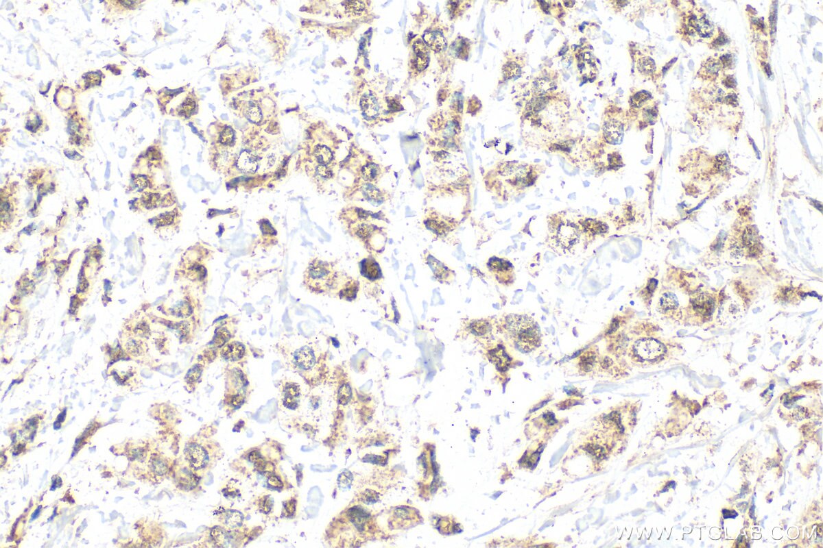 Immunohistochemistry (IHC) staining of human breast cancer tissue using Kallikrein 6 Polyclonal antibody (12264-1-AP)