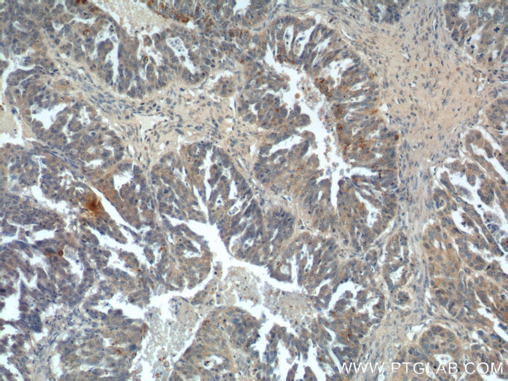 IHC staining of human ovary tumor using 14232-1-AP