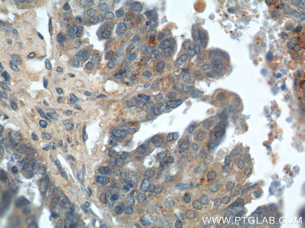 Immunohistochemistry (IHC) staining of human ovary tumor tissue using Kallikrein 8 Polyclonal antibody (14232-1-AP)