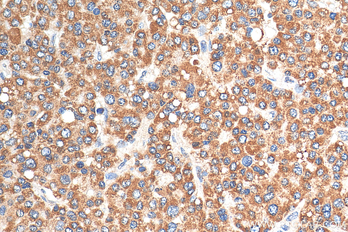 Immunohistochemistry (IHC) staining of human liver cancer tissue using KLKB1 Polyclonal antibody (27991-1-AP)