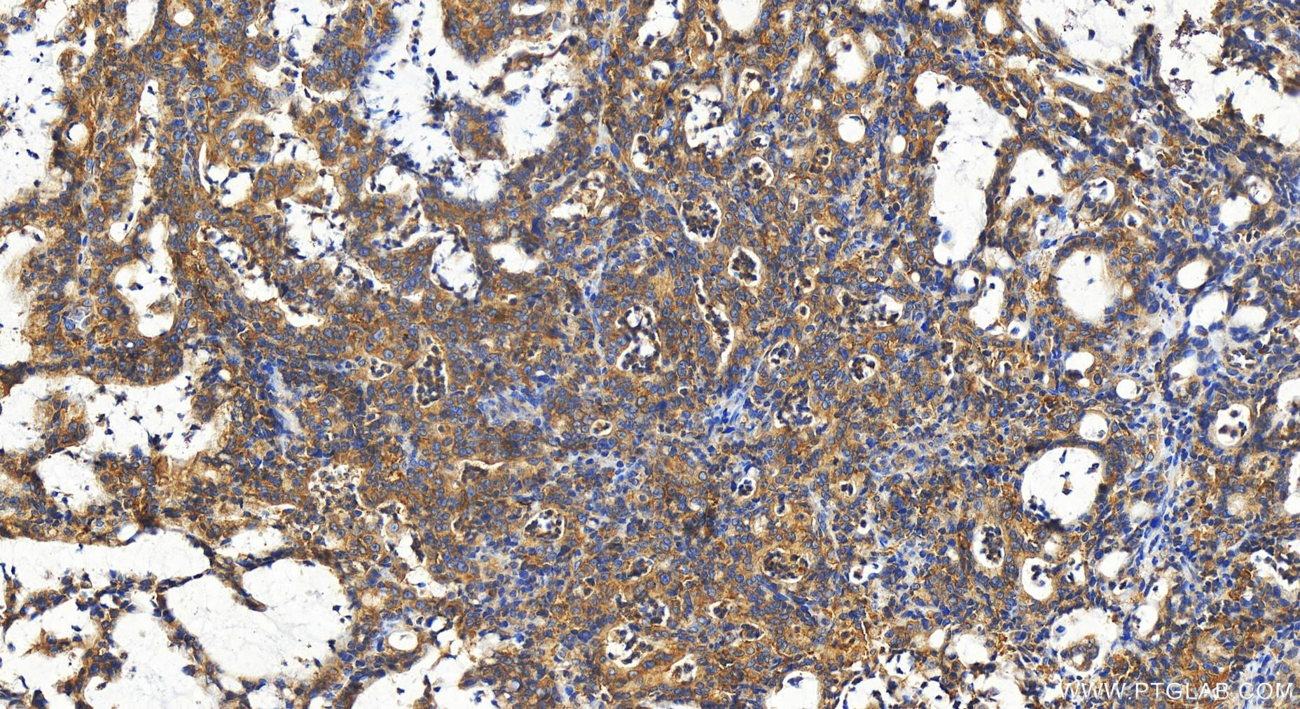 Immunohistochemistry (IHC) staining of human stomach cancer tissue using PPP1R21 Polyclonal antibody (31532-1-AP)
