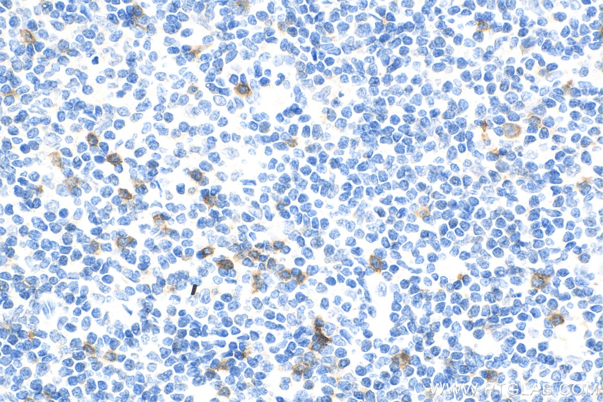 Immunohistochemistry (IHC) staining of human tonsillitis tissue using NKG2A Polyclonal antibody (10935-1-AP)
