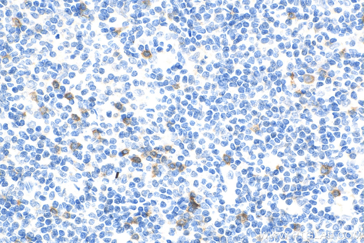 IHC staining of human tonsillitis using 10935-1-AP