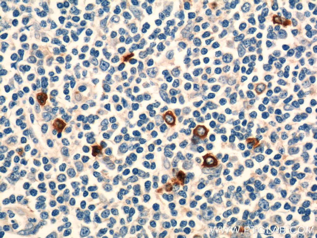 Immunohistochemistry (IHC) staining of human tonsillitis tissue using KLRF1 Polyclonal antibody (21510-1-AP)