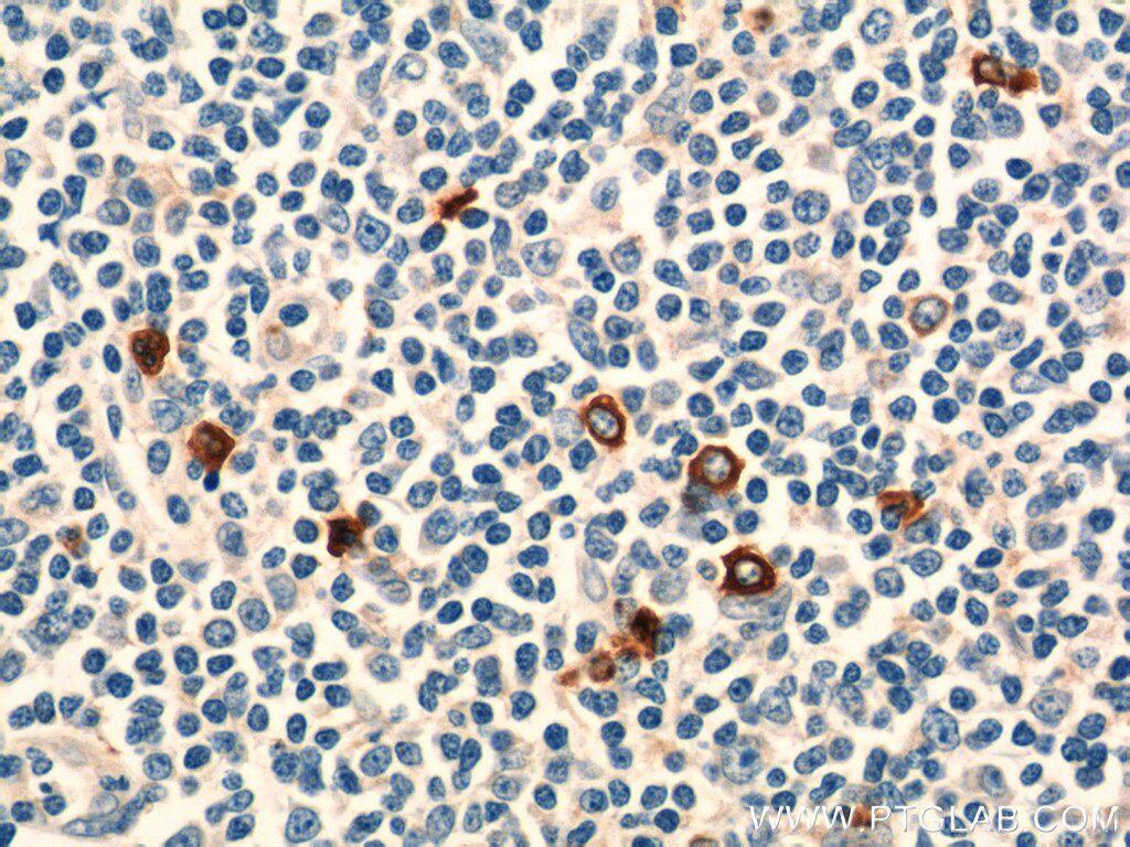 IHC staining of human tonsillitis using 21510-1-AP